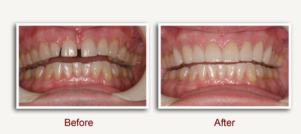 Before and After Dental Photo