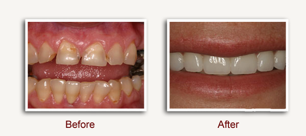 Before and After Dental Photo